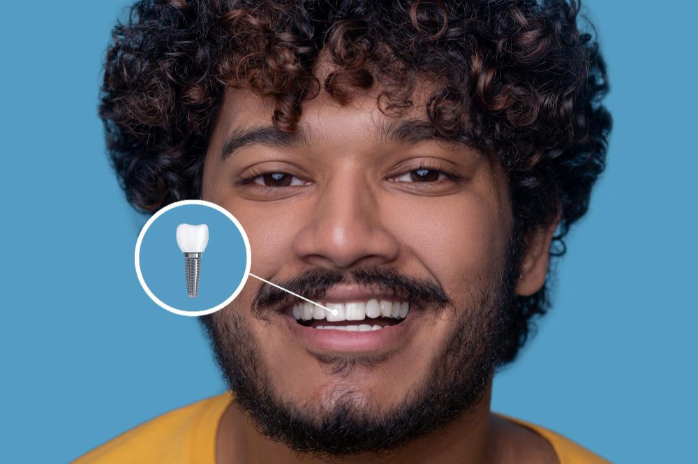 Young man with a toothy smile demonstrating his dental implant