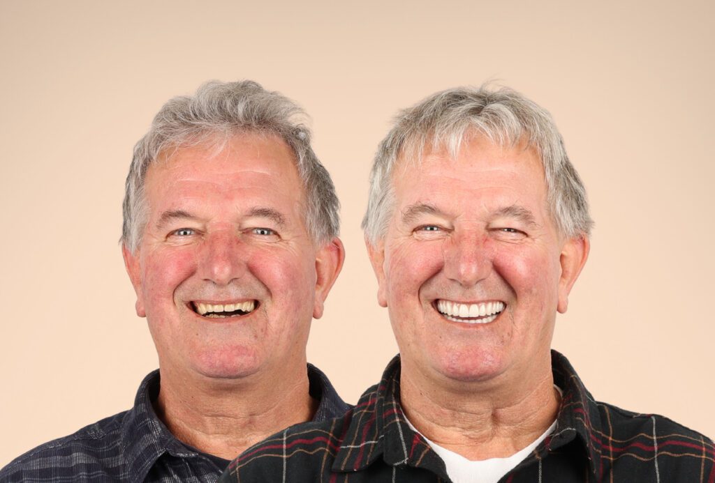 Laurence Hodgkins Before&After _ Dr Brian Johnston DEN0001007940_01