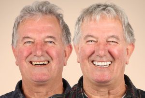 Fixed Teeth Australia | Lawrence made the change Laurence Hodgkins Before&After _ Dr Brian Johnston DEN0001007940_01