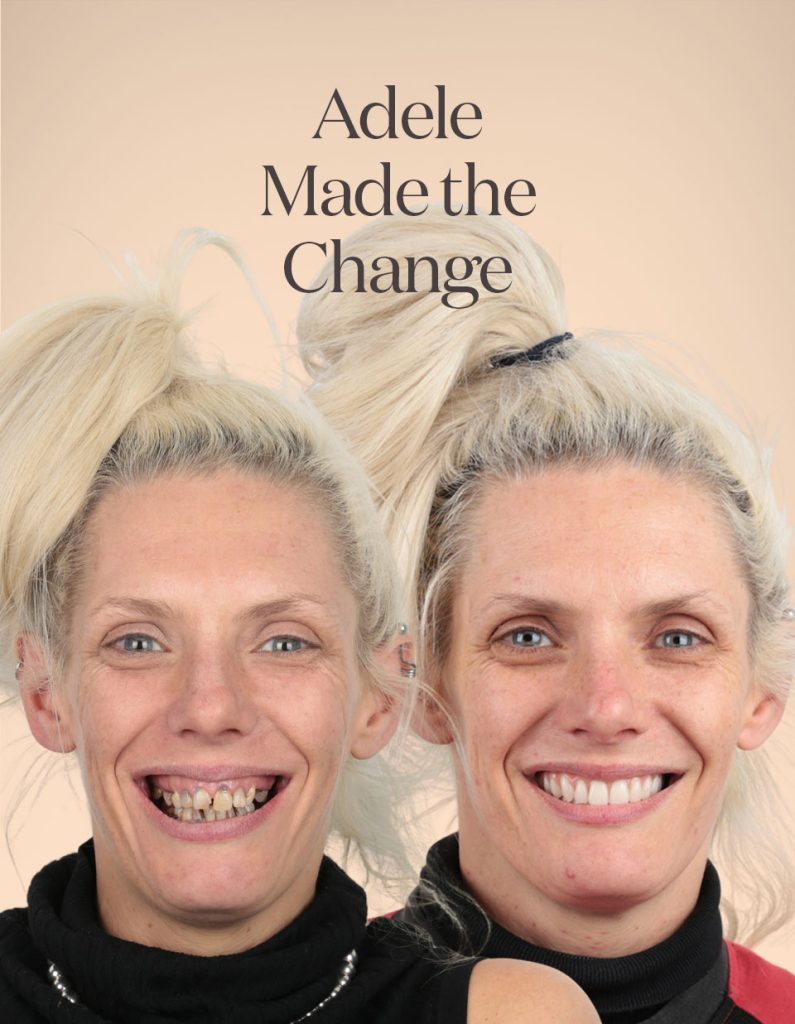 Adele before and after treatment