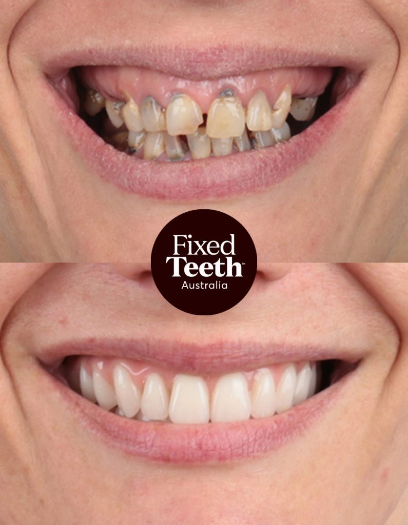 Fixed Teeth Australia|Before & Afters
