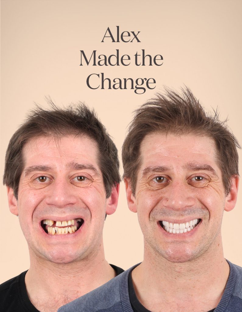 Alex before and after treatment