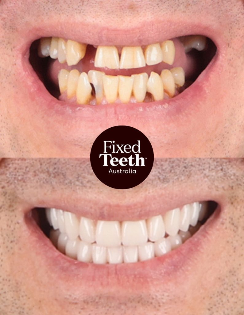 Fixed Teeth Australia|Before & Afters