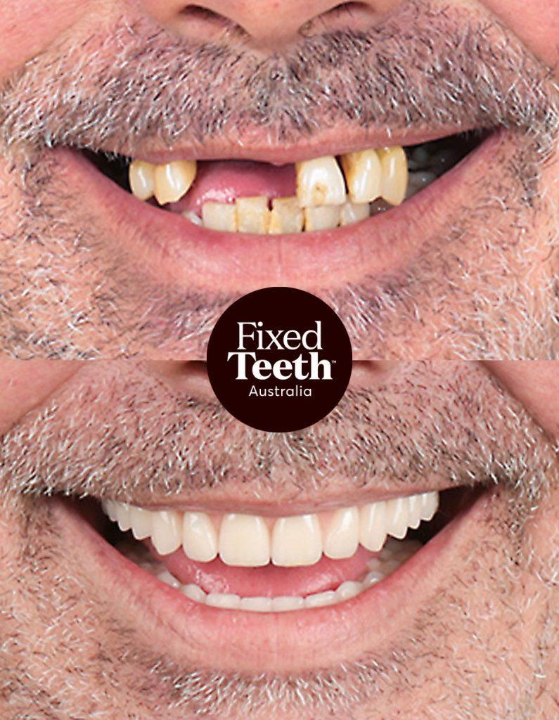 Fixed Teeth Australia|Before & Afters