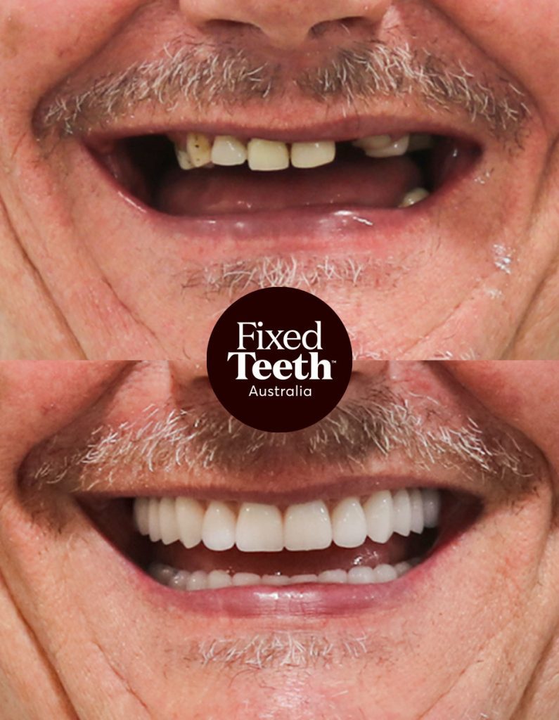 Fixed Teeth Australia|Before & Afters