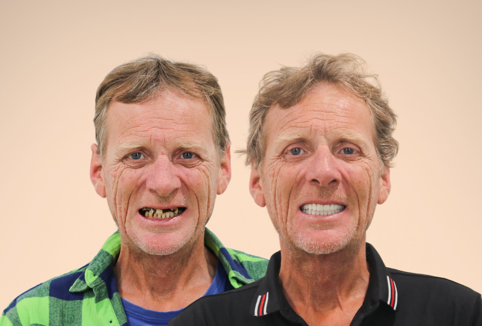 Full Mouth Dental Implants and Chewing Function: Daryl’s Story