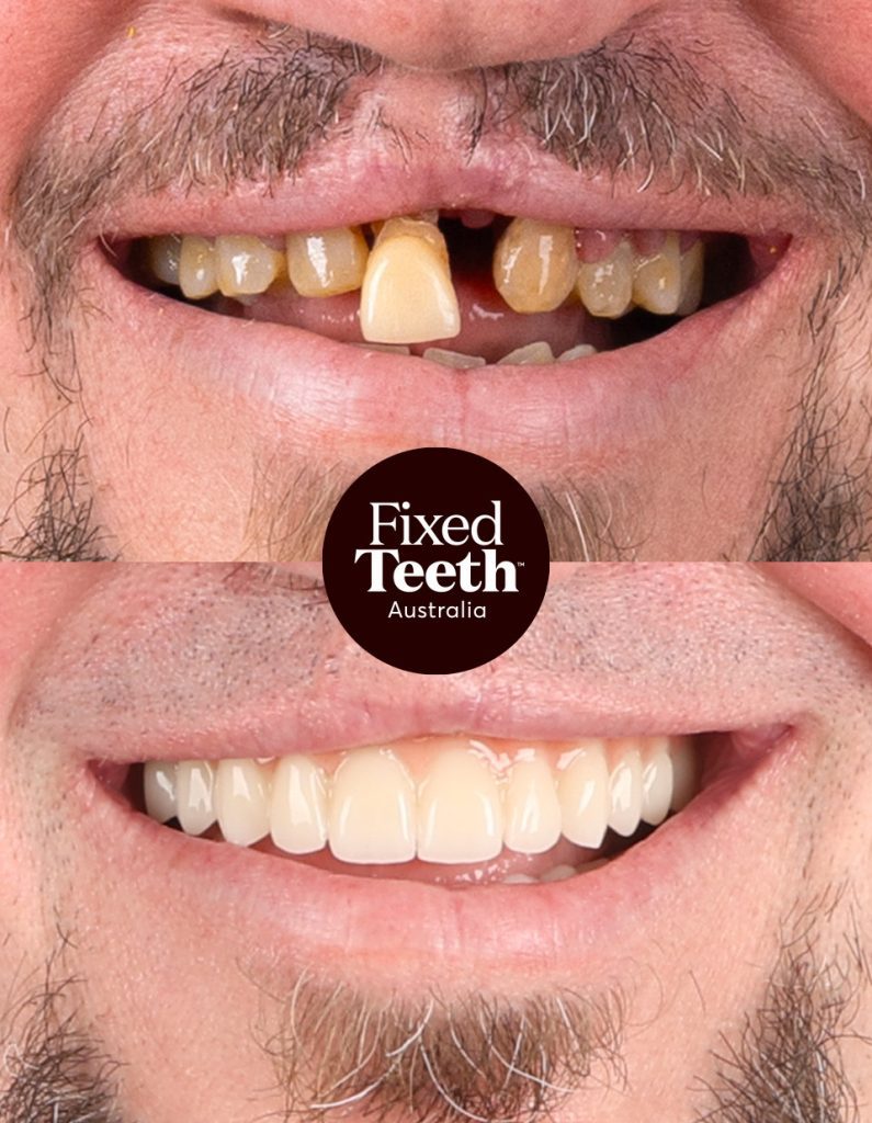 Fixed Teeth Australia|Before & Afters