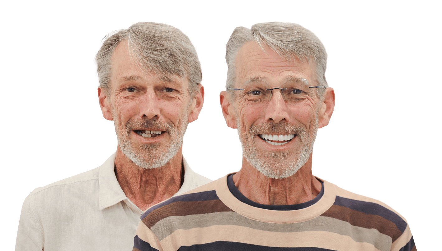 Fixed Teeth Australia|Before & Afters