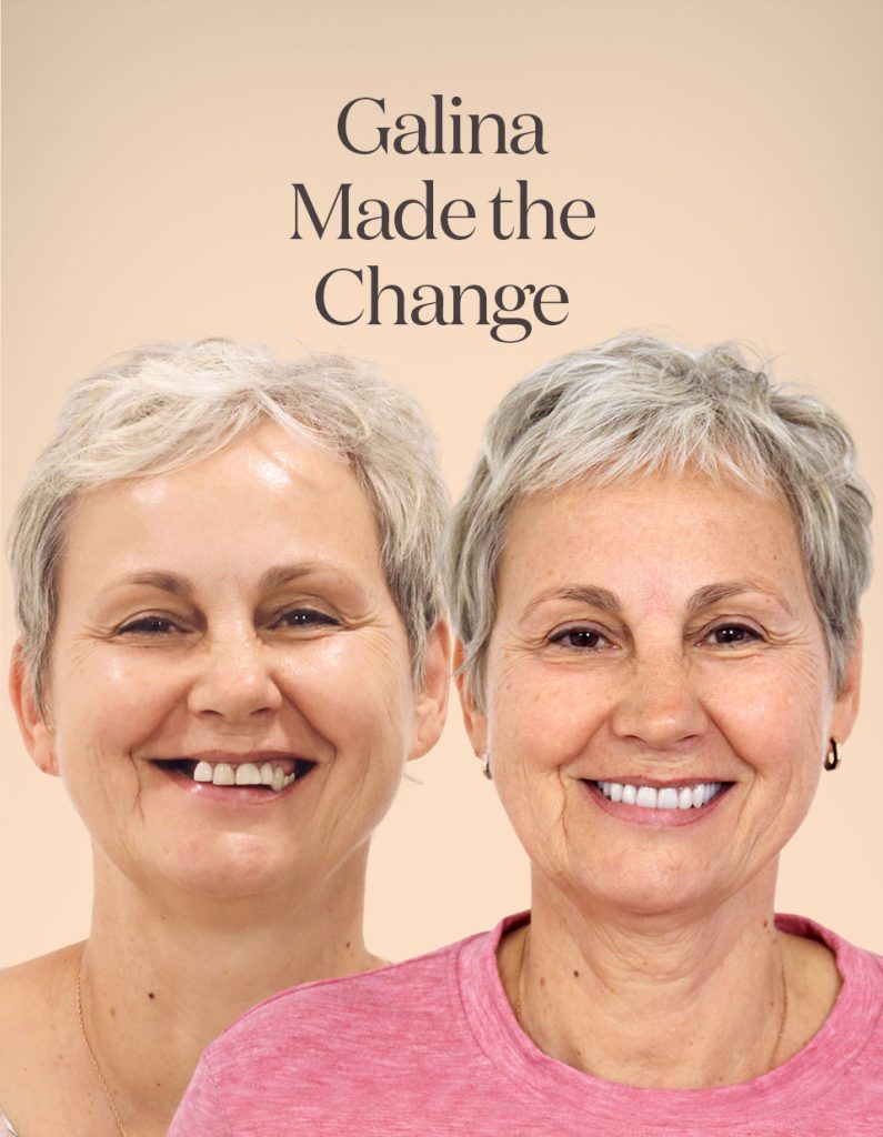 Galina before and after treatment