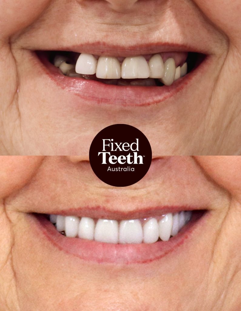 Fixed Teeth Australia|Before & Afters
