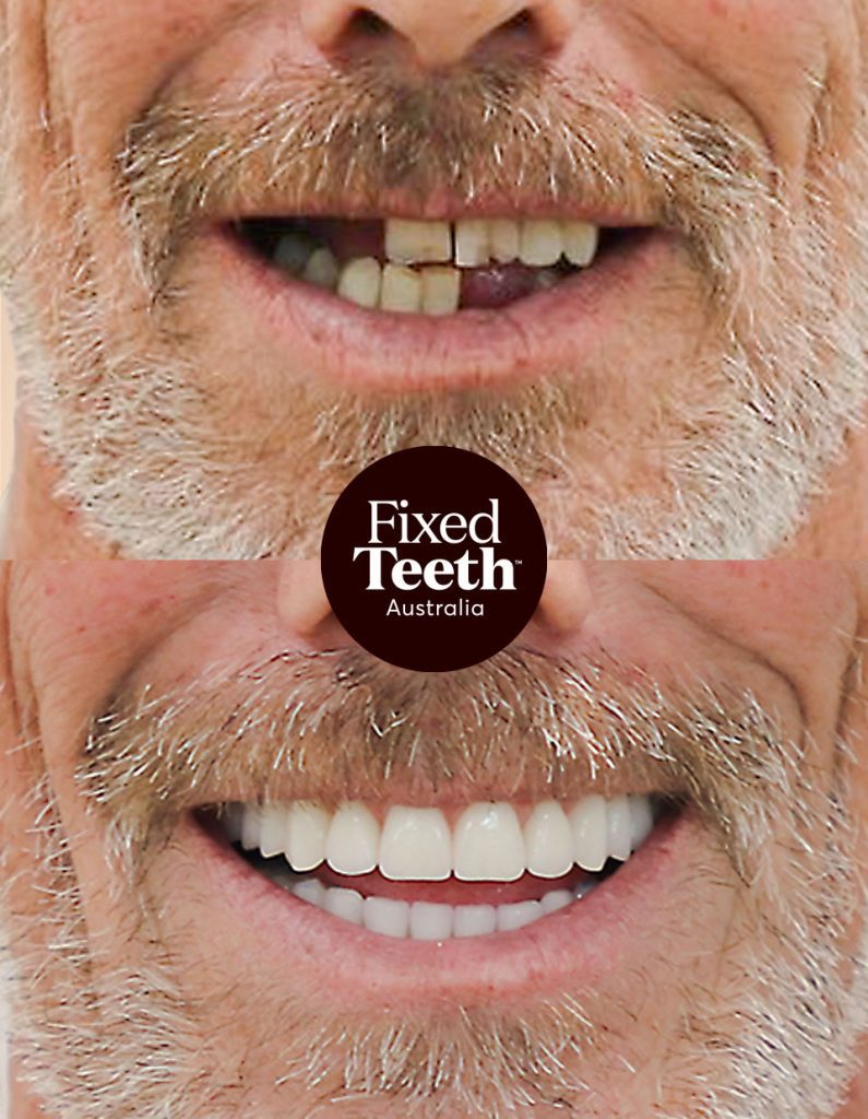 Fixed Teeth Australia|Before & Afters