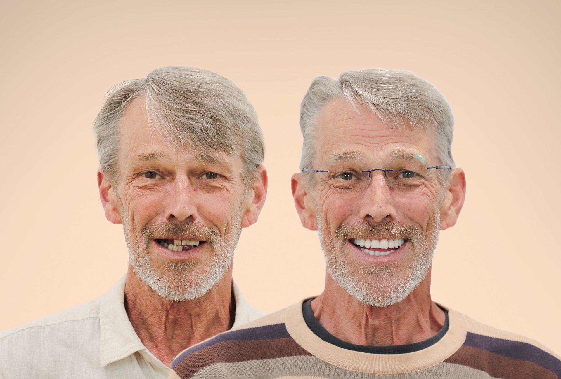Full Mouth Dental Implants Without Bone Grafting: Ian’s Story