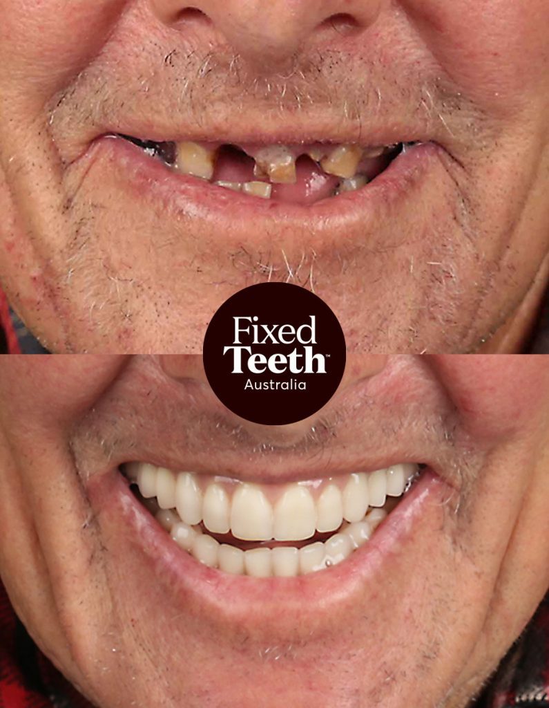 Fixed Teeth Australia|Before & Afters