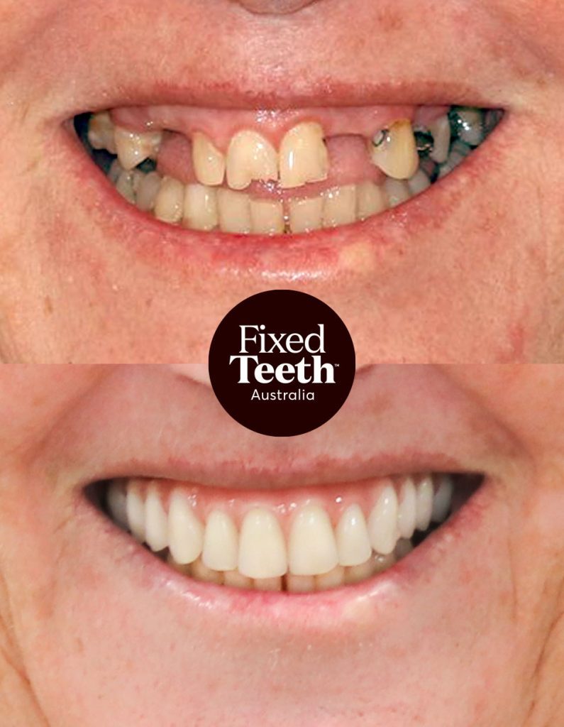 Fixed Teeth Australia|Before & Afters