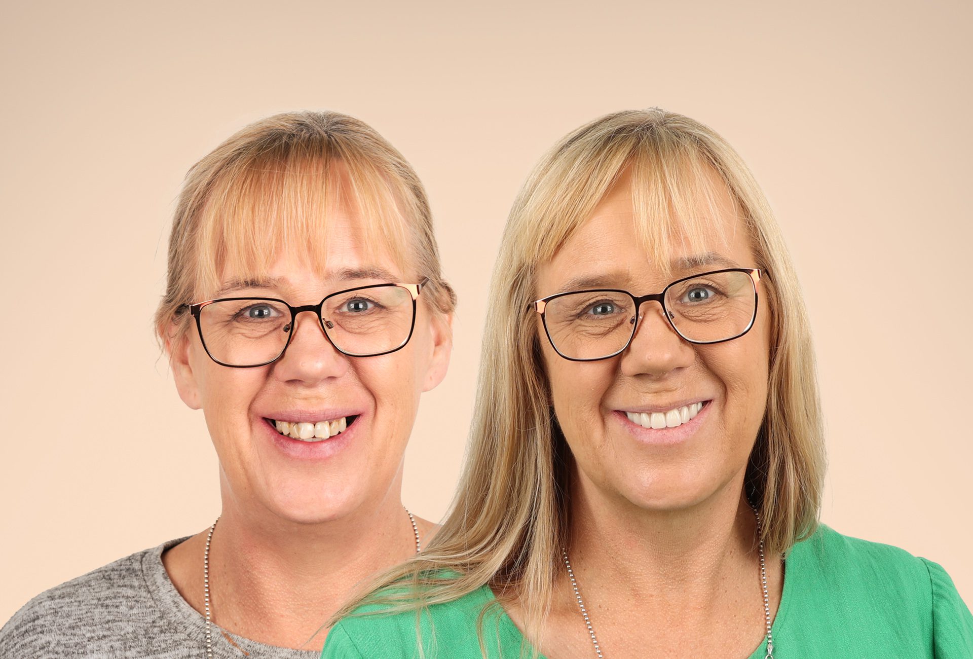 Dental Implants with Jawbone Loss: Margaret’s Story