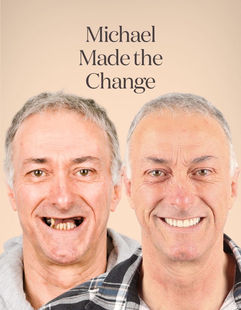 Michael before and after treatment