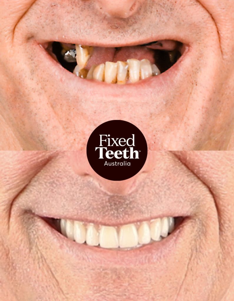 Fixed Teeth Australia|Before & Afters
