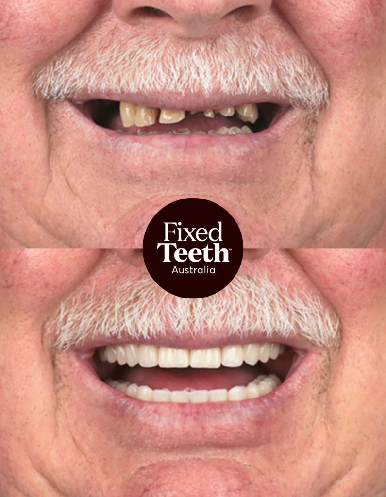 Fixed Teeth Australia|Before & Afters