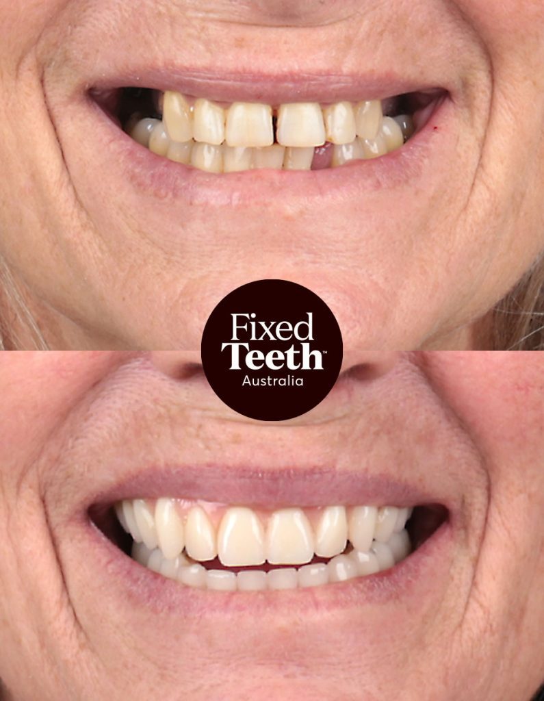 Fixed Teeth Australia|Before & Afters